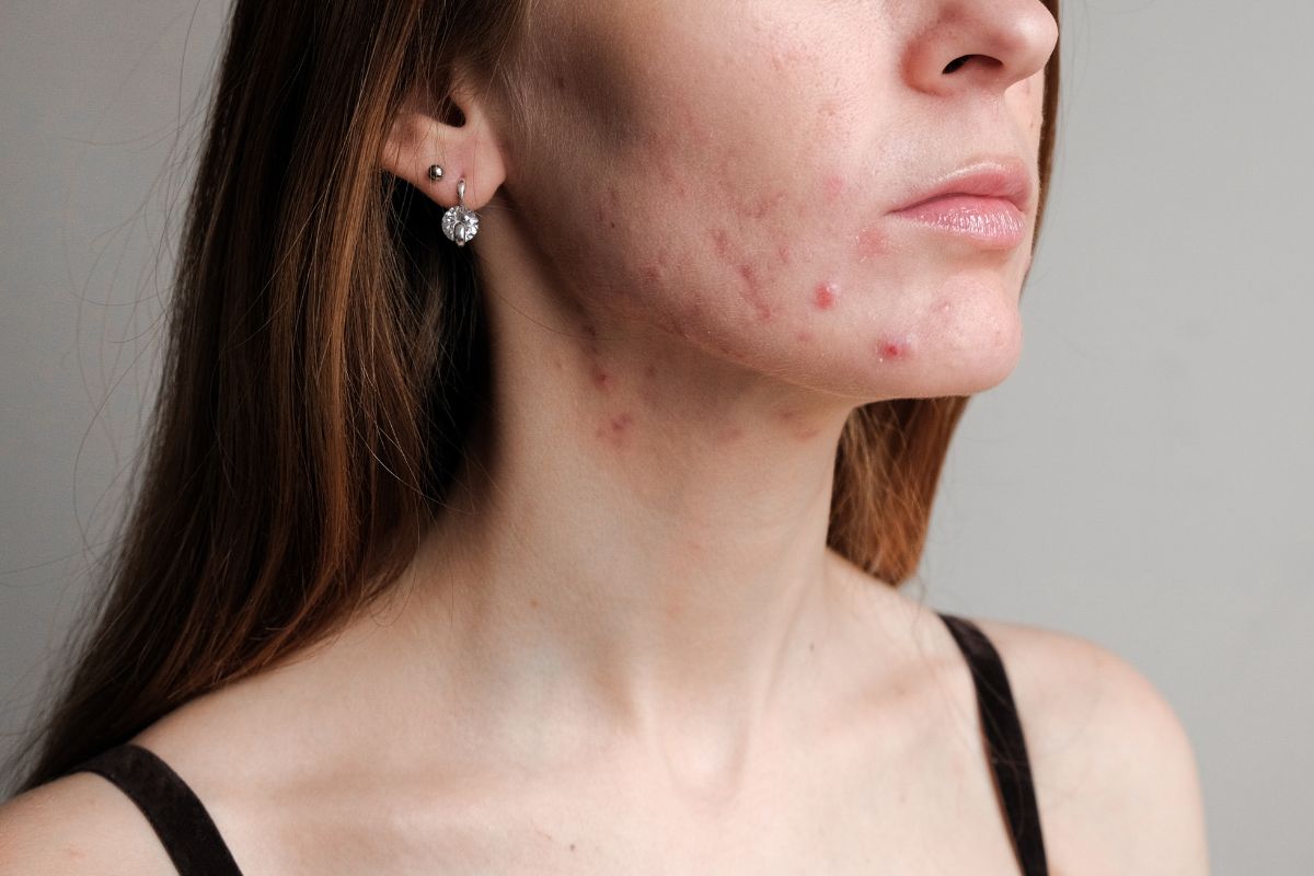acne-treatments-at-facebeauty-med-spa-doral-fl.jpg